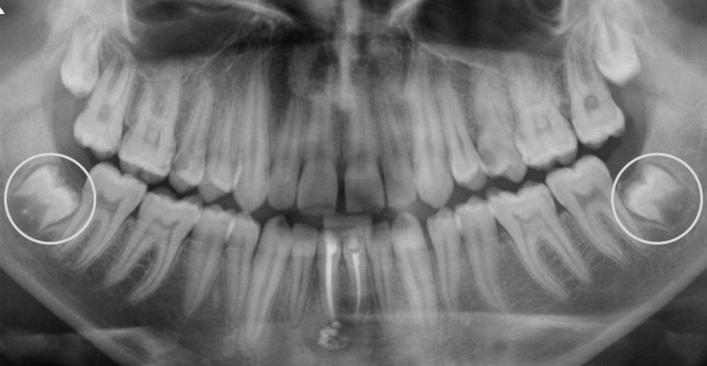 Surgical Extractions – Dr. Ioannis Vergoullis